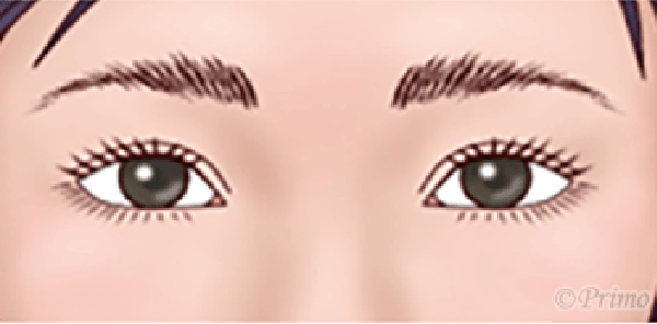 下眼瞼拡大修正術 後の目元イラスト